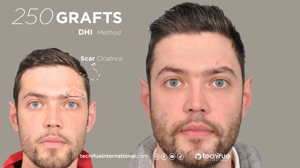 Greffe de Sourcils Homme