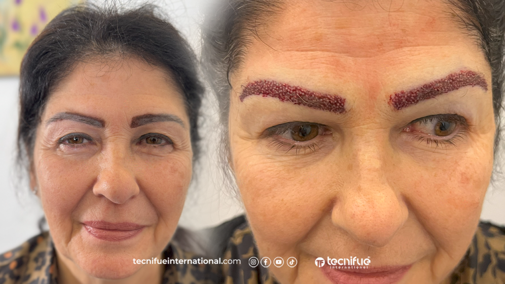 Greffe de Sourcils Femme