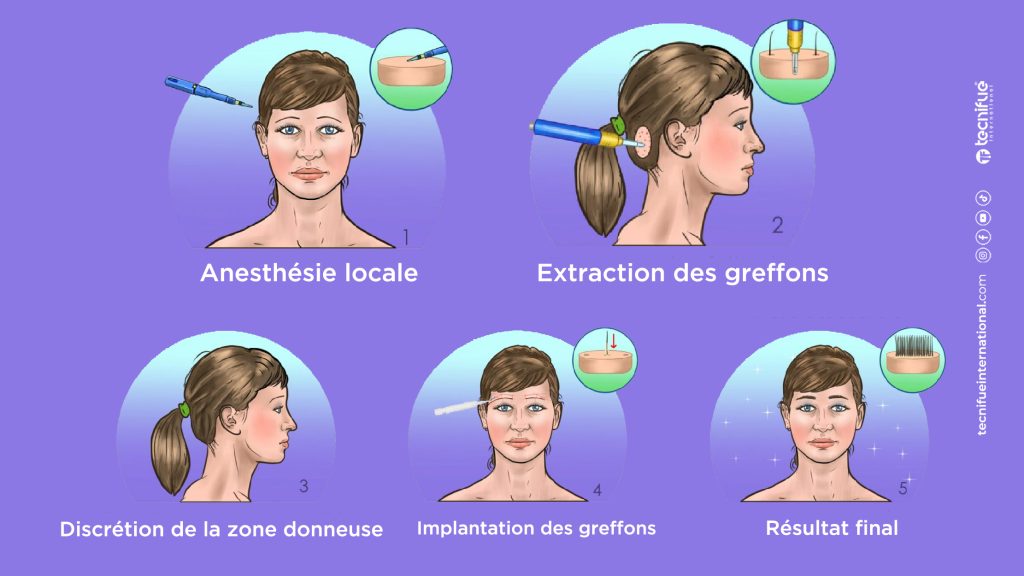 Greffe de Sourcils en Turquie