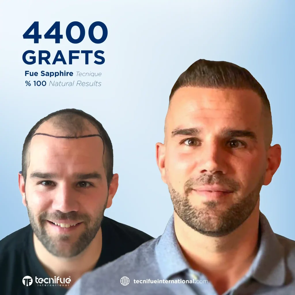 Hair Transplant After ten Years Paul