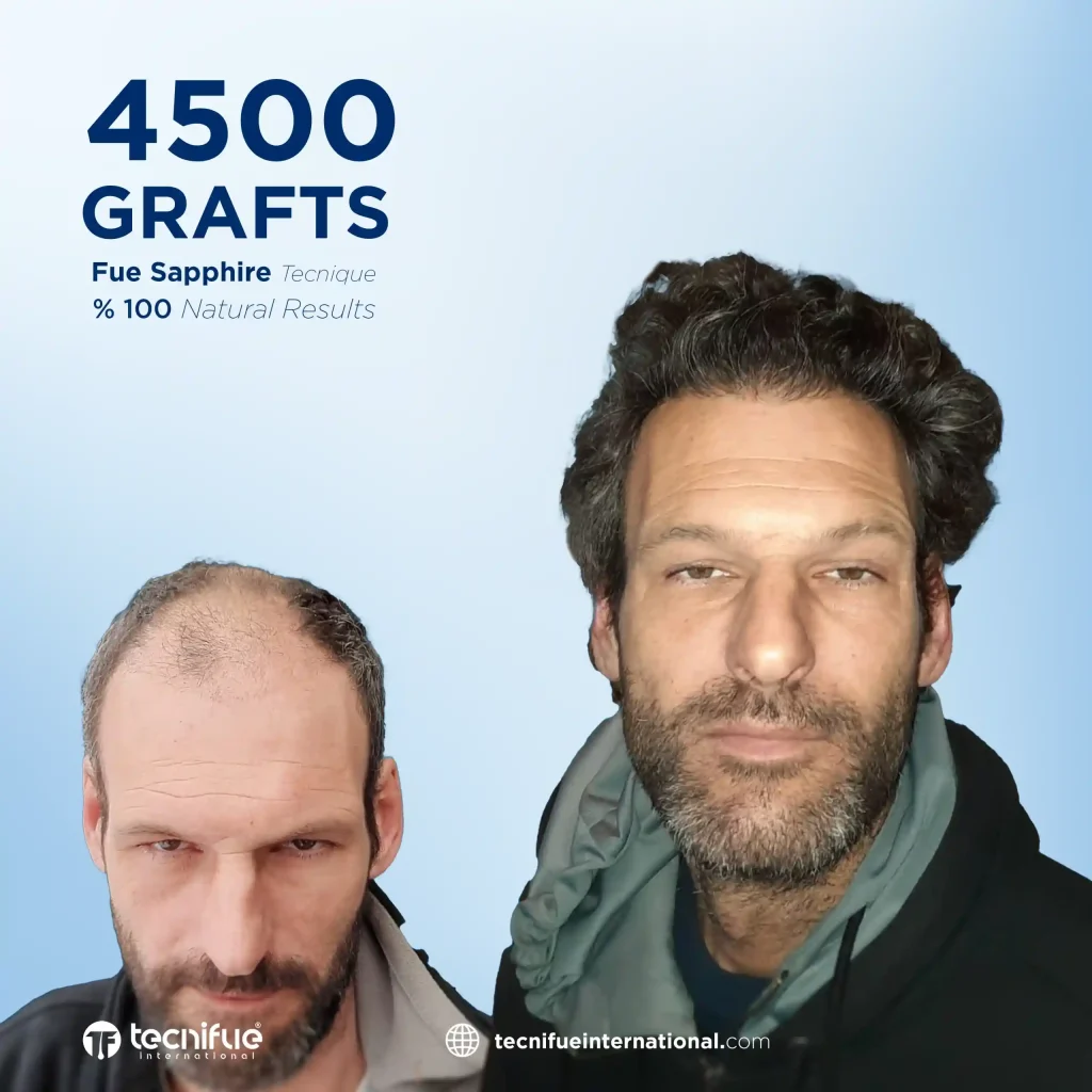 Hair Transplant Before and After FUE Sapphire 4.500 Grafts 