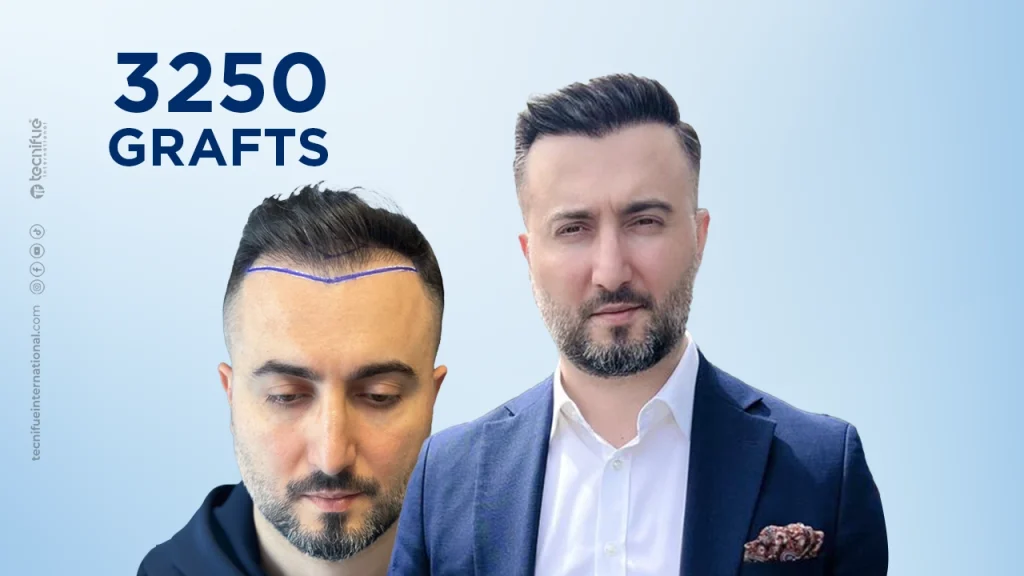 Hair Transplant Before and After DHI No Shave 3.250 Grafts