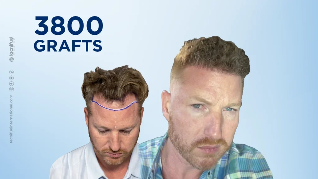 Hair Transplant Before and After DHI 3.800 Grafts