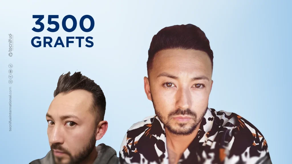 Hair Transplant Before and After FUE Sapphire 3.500 Grafts
