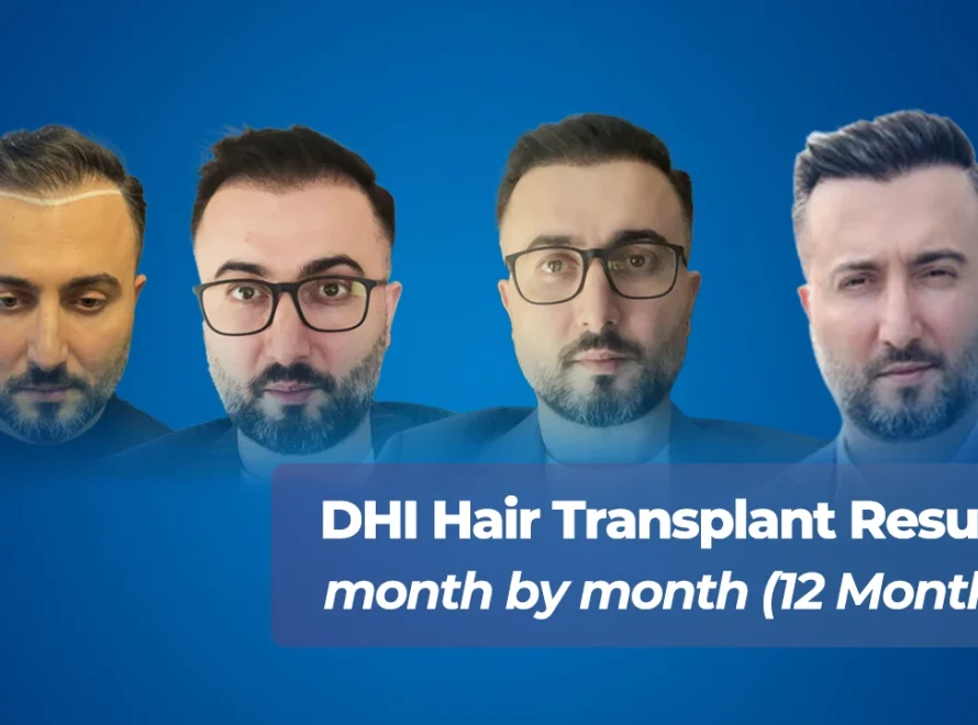 DHI Hair Transplant Results Month by Month