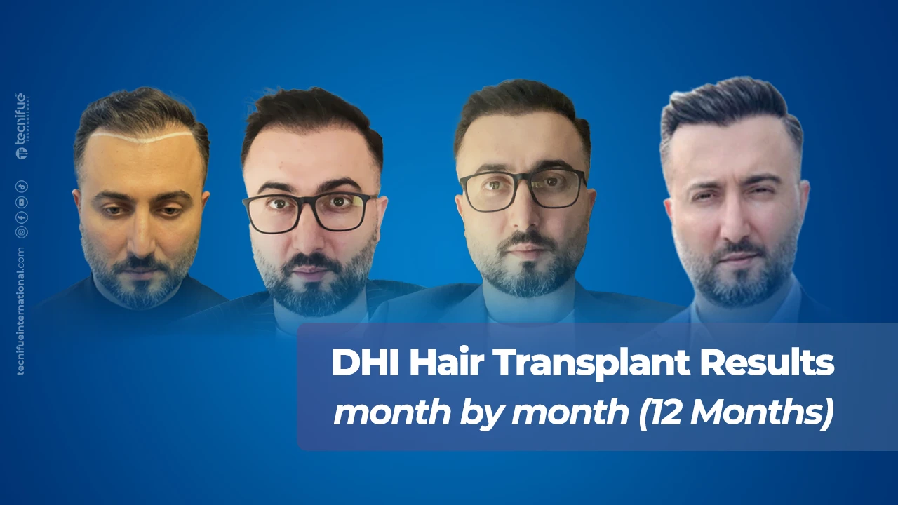 DHI Hair Transplant Results Month by Month