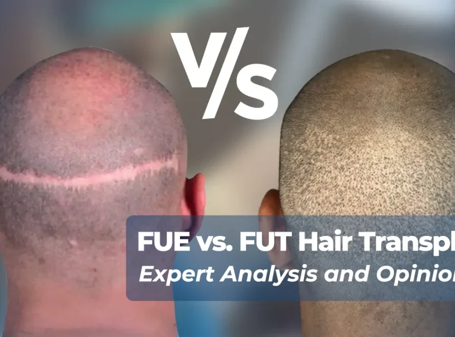 FUE vs. FUT Hair Transplant: Image showing the FUT Scar and FUE scars
