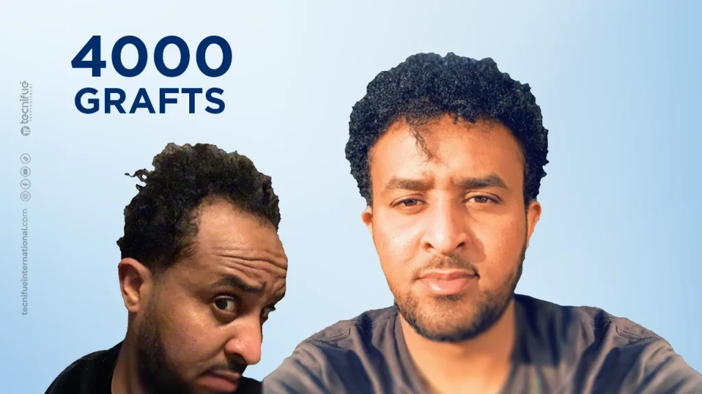 Hair Transplant  Before and After FUE Sapphire 4.000 Grafts