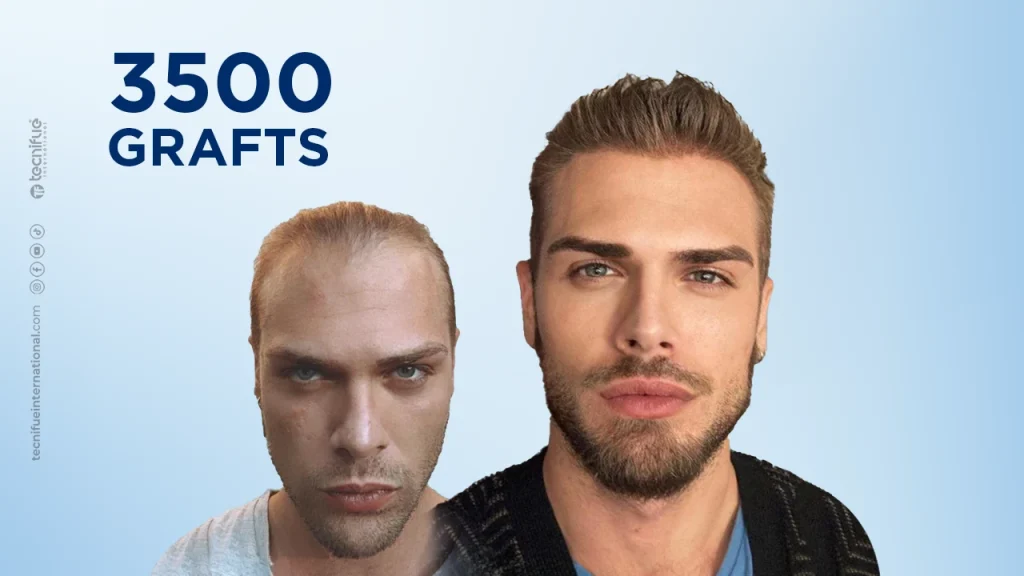 Hair Transplant Before and After FUE Sapphire 3.500 Grafts