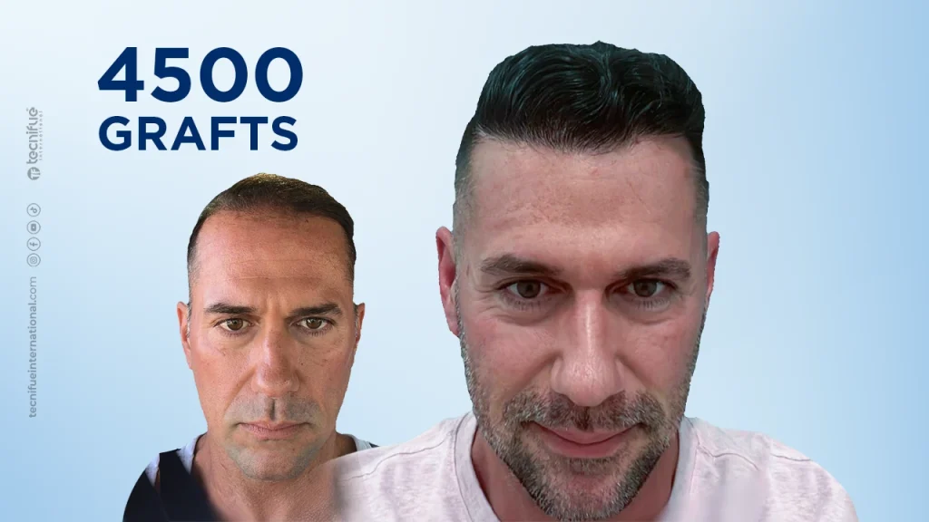 Before and After Hair Transplant FUE Sapphire 4.000 Grafts