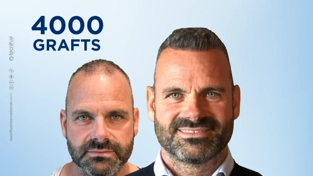 Hair Transplant Before and After 4.000 Grafts