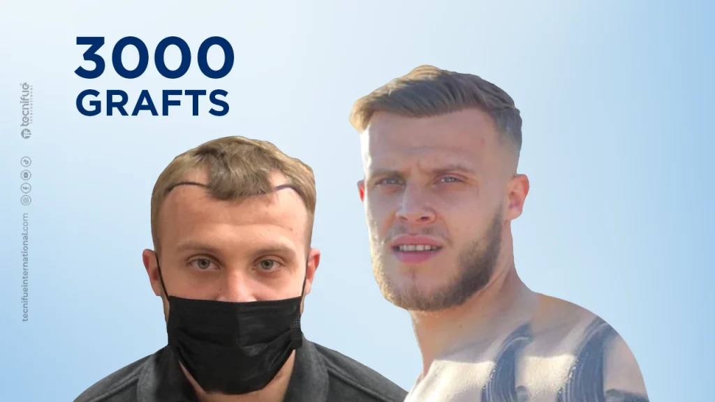 Hair Transplant Before and After FUE Sapphire 3.000 Grafts