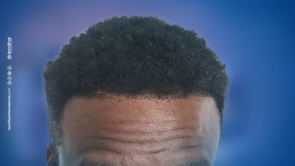 12 Months Result After Necrosis