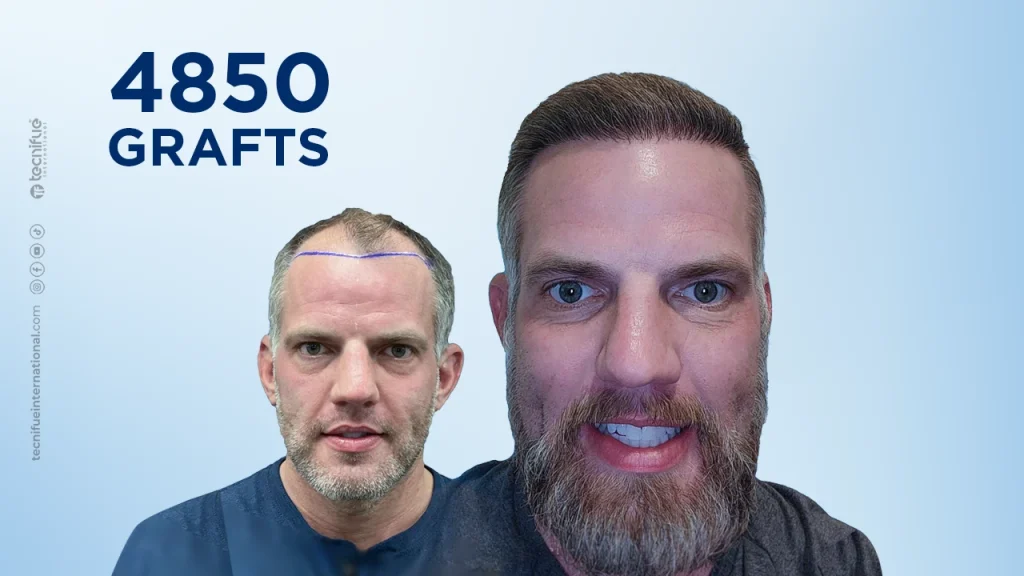Hair  Transplant Before and After DHI 4.850 Grafts