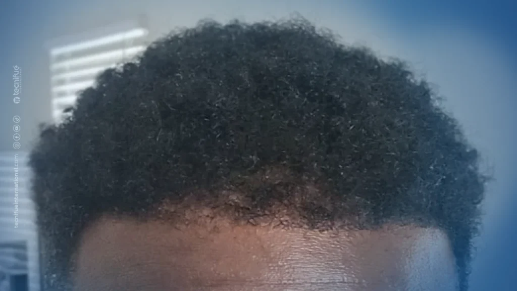 6 Months Result After Necrosis