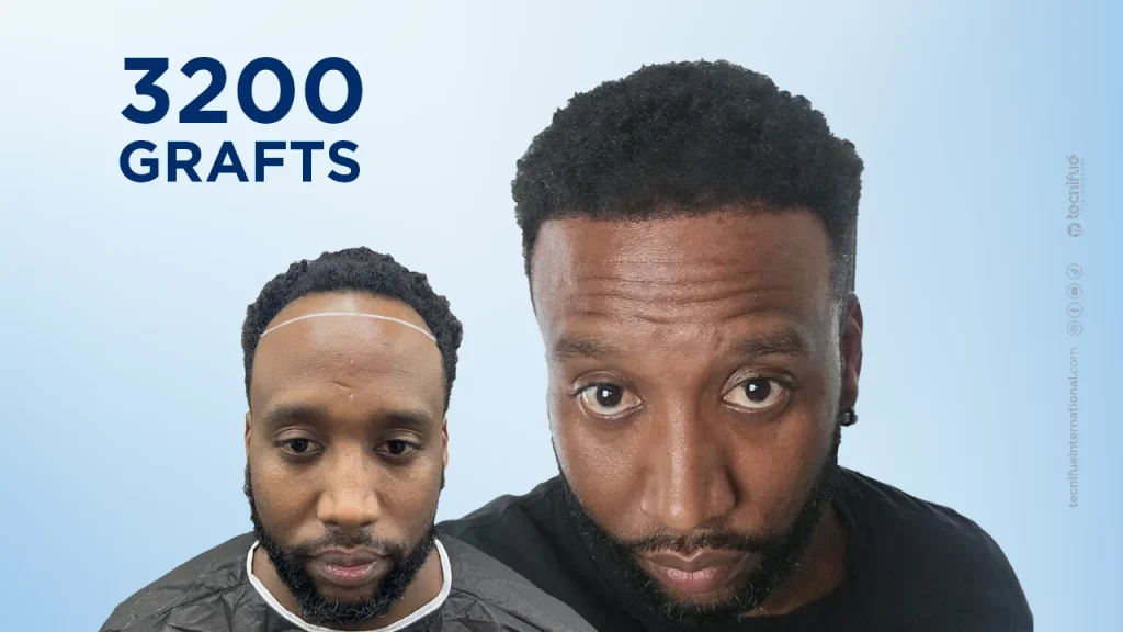 African American Hair Transplant Before and After 