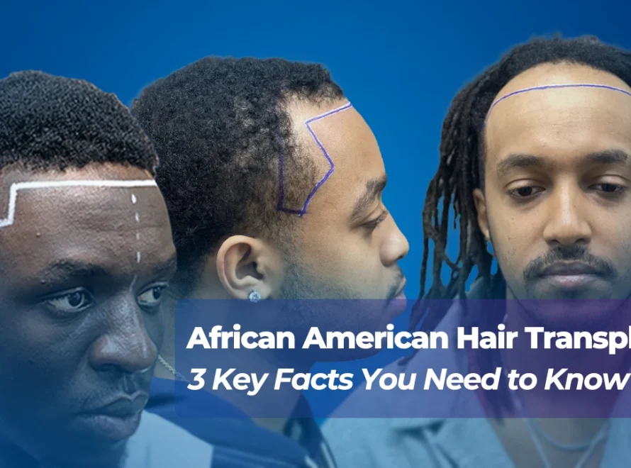 African American Hair Transplant