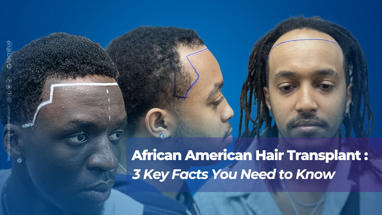 African American Hair Transplant