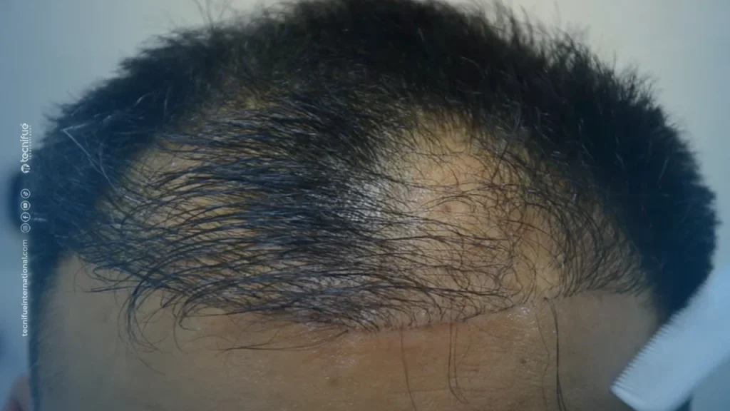 Example Bad Hair Transplant Result from the Internet