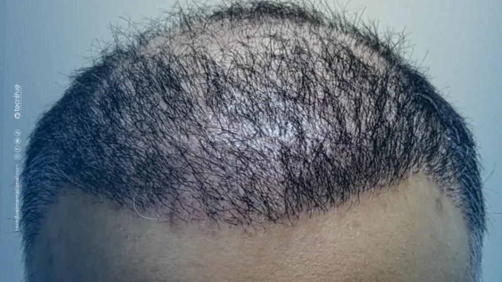 Example Bad Hair Transplant