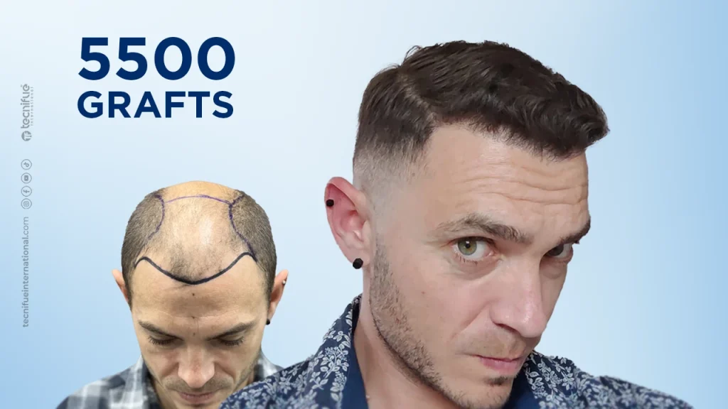 Hair Transplant  Before and After FUE Sapphire 5.500 Grafts 