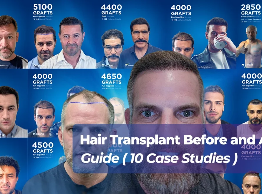 Hair Transplant Before and After Cover