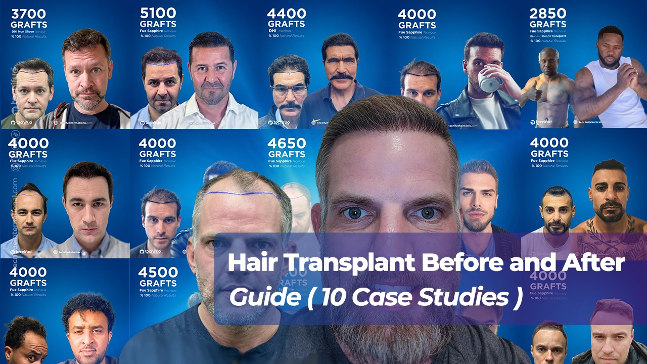 Hair Transplant Before and After Cover