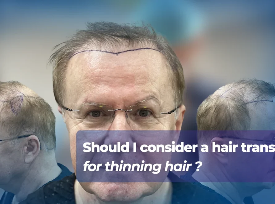 hair transplant for thinning hair