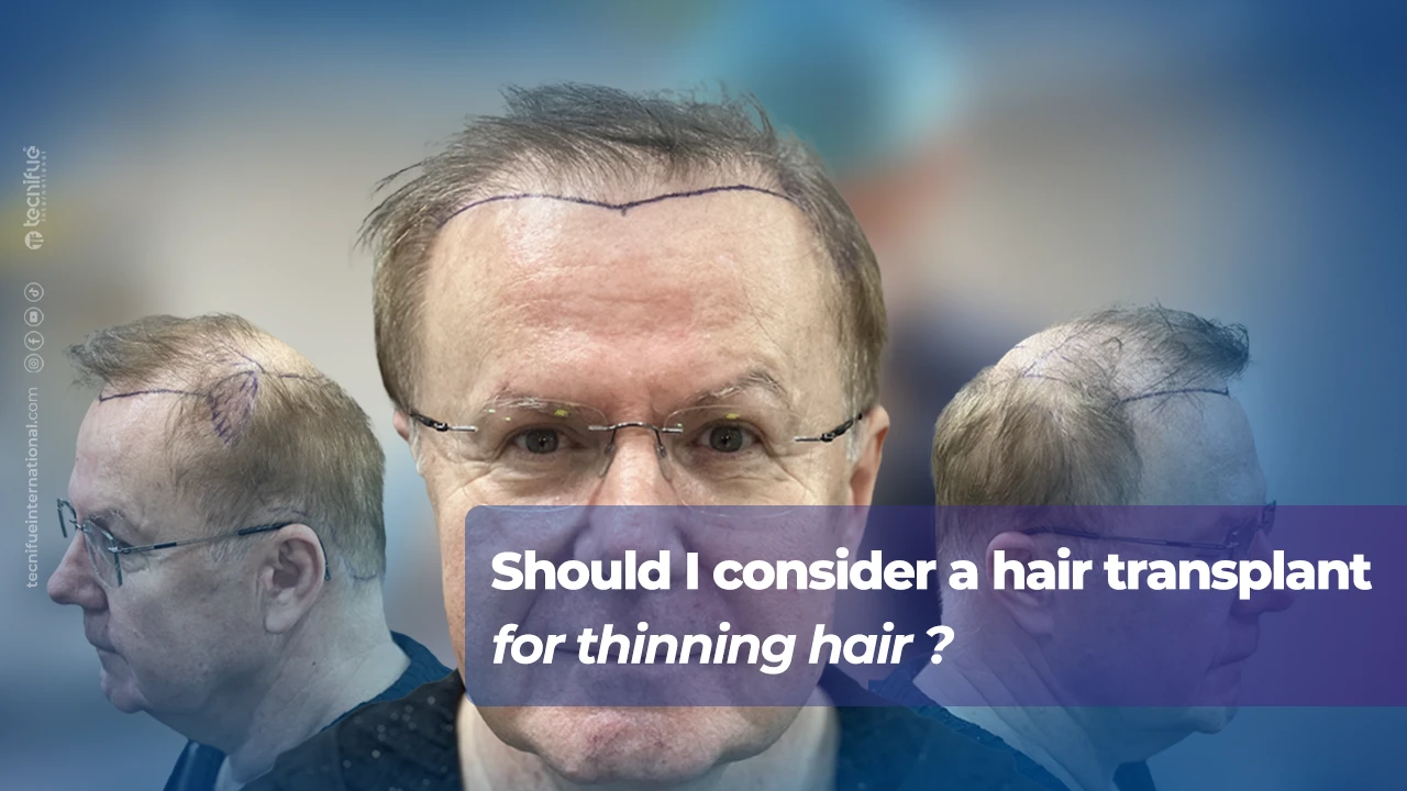hair transplant for thinning hair