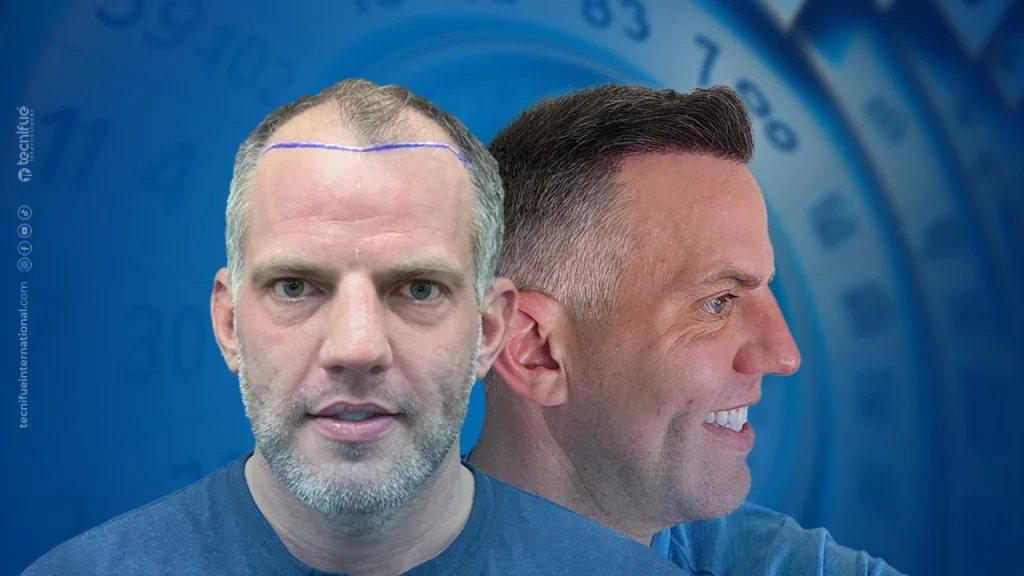 Hair Transplant After 10 Years