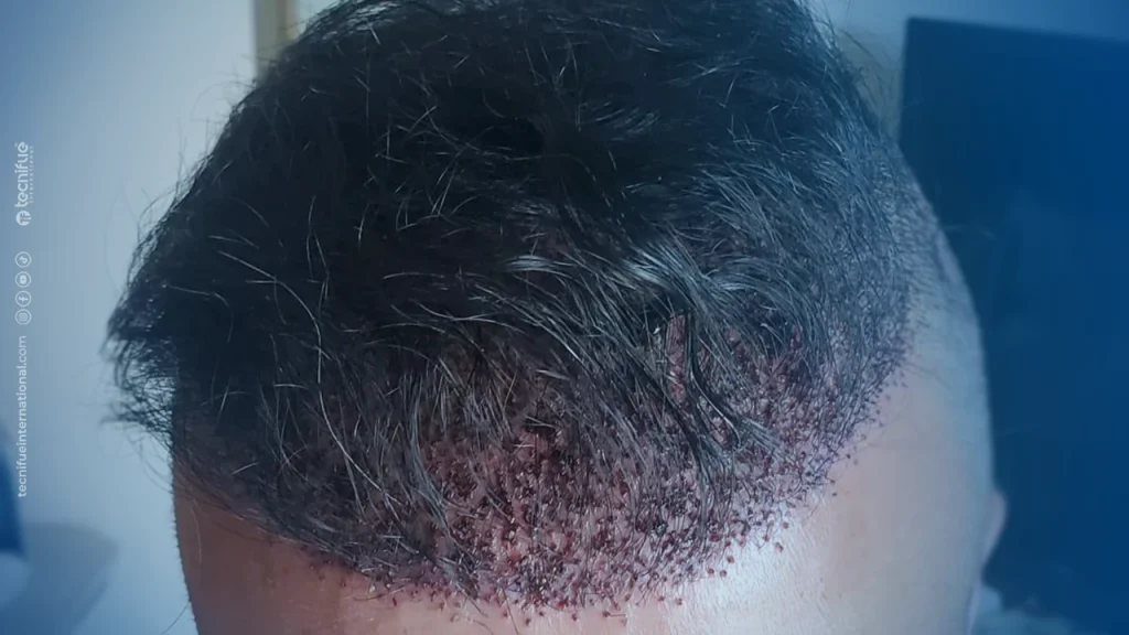 Hair Transplant Correction After 5 Days with Scabs