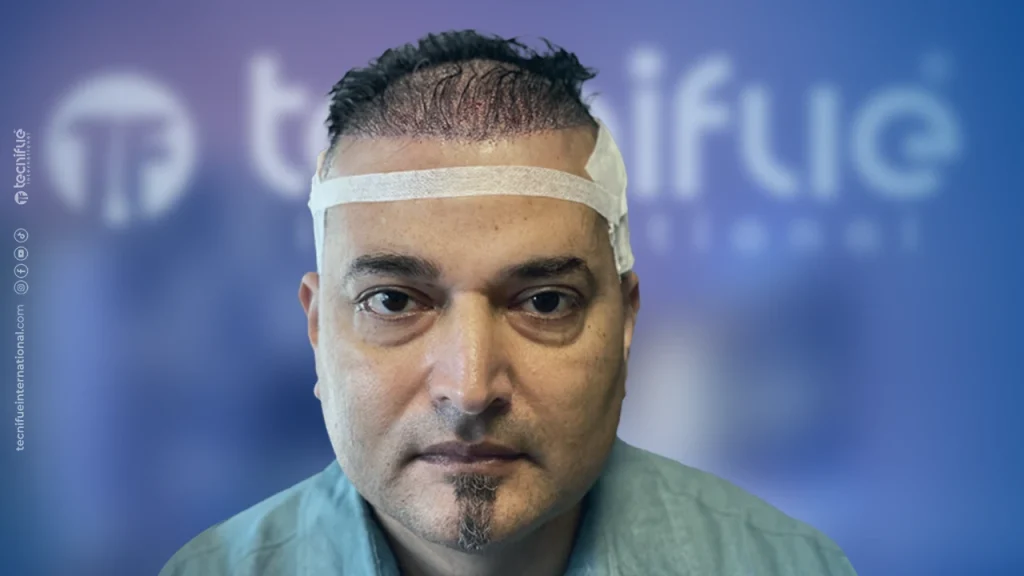 Hair Transplant Correction After Surgery