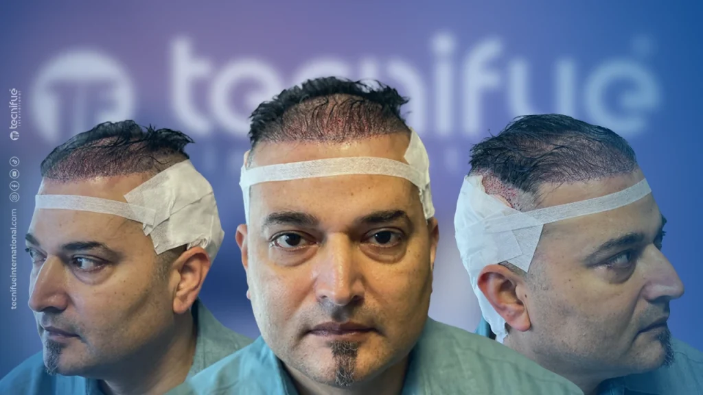 Hair Transplant Correction After Surgery All Angles