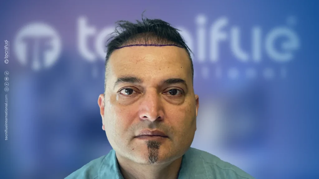 Hair Transplant Correction Before Surgery