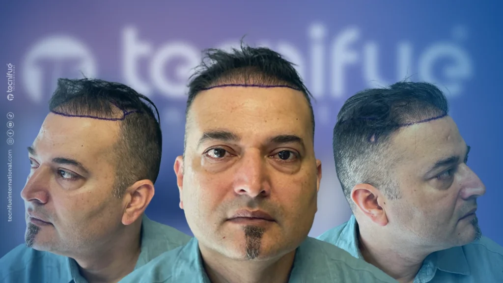 Hair Transplant Correction Before Surgery All Angles