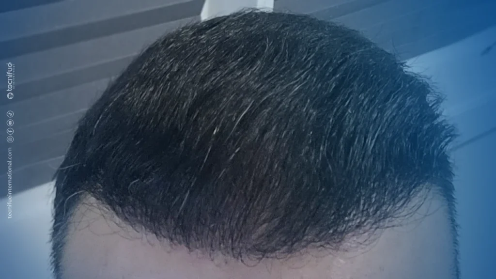 Hair Transplant Correction  Surgery After 6 Months
