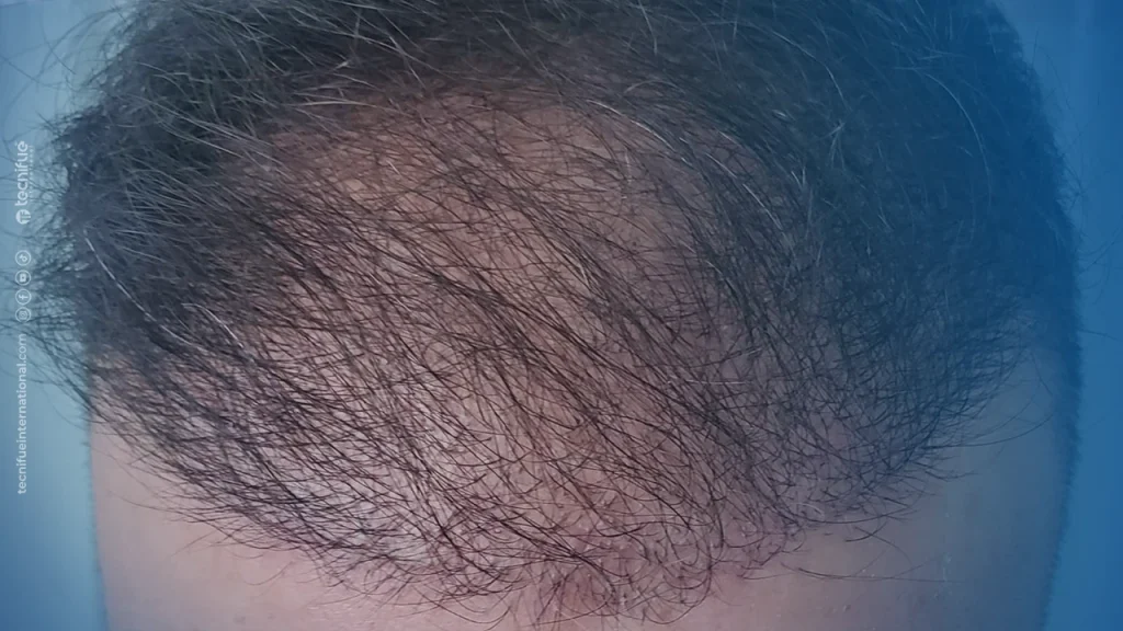 Hair Transplant Correction Surgery After 8 Days
