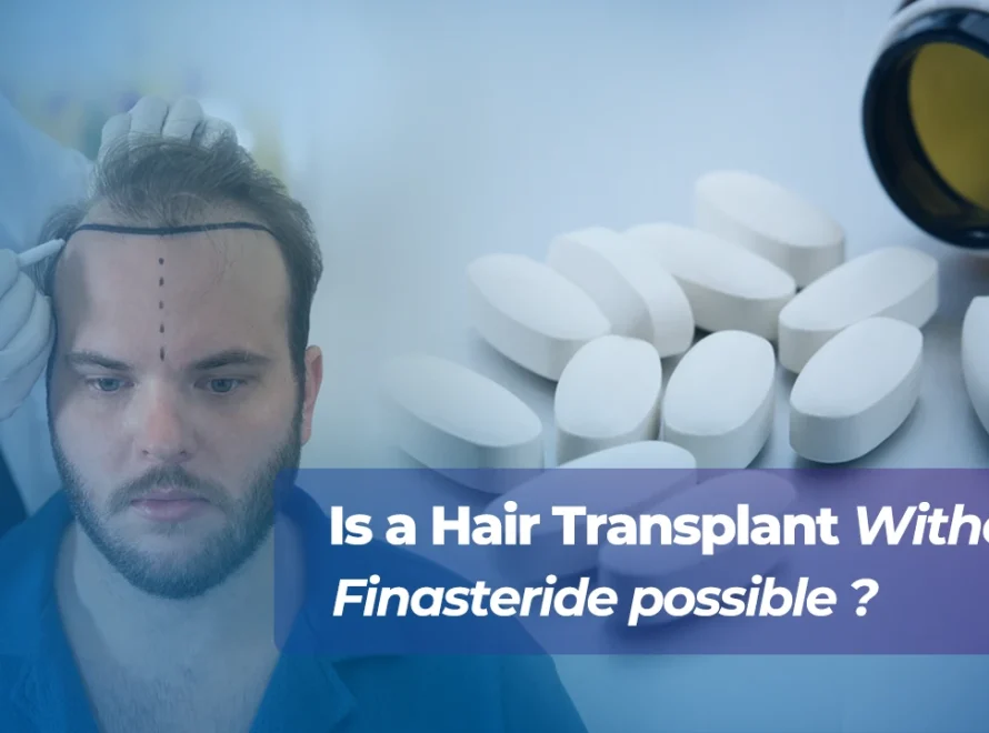 Is a hair transplant without finasteride possible?