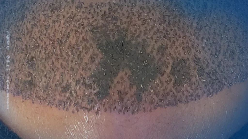 Necrosis After Hair Transplant