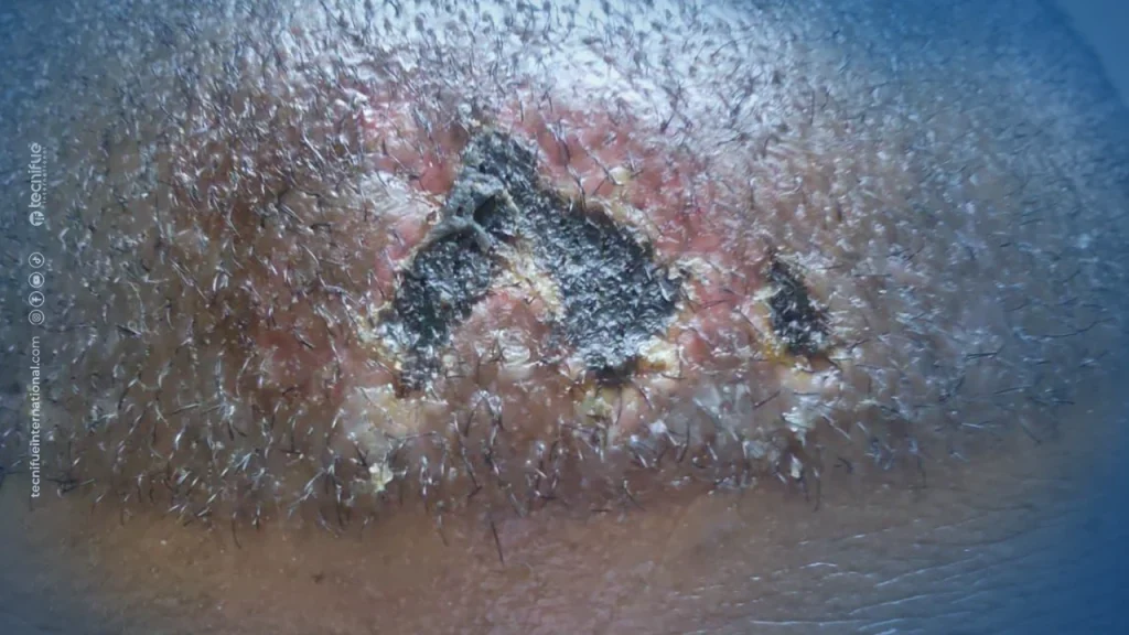 Necrosis After Hair Transplant Day 6