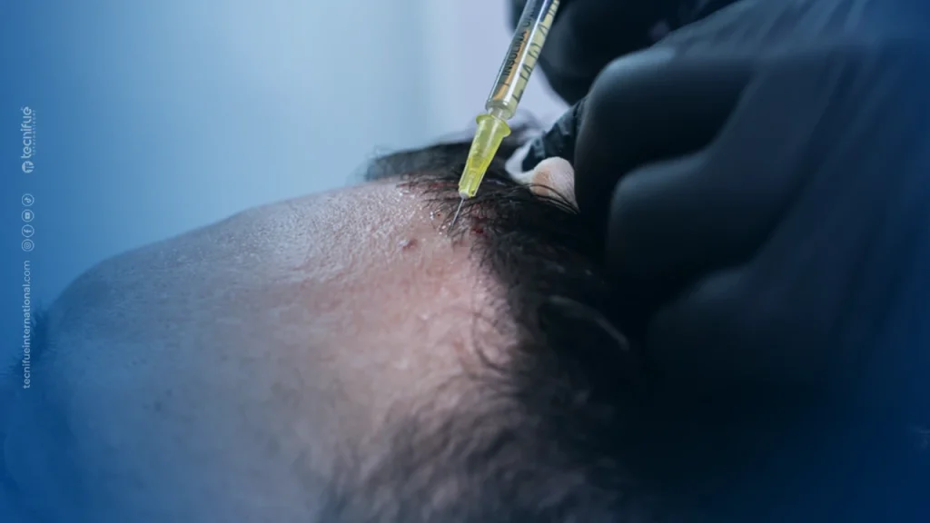 PRP Hair Treatment After Hair Transplant