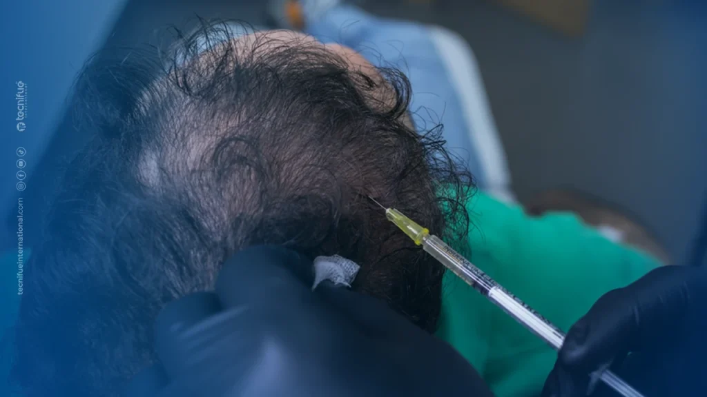 PRP for Thinning Hair