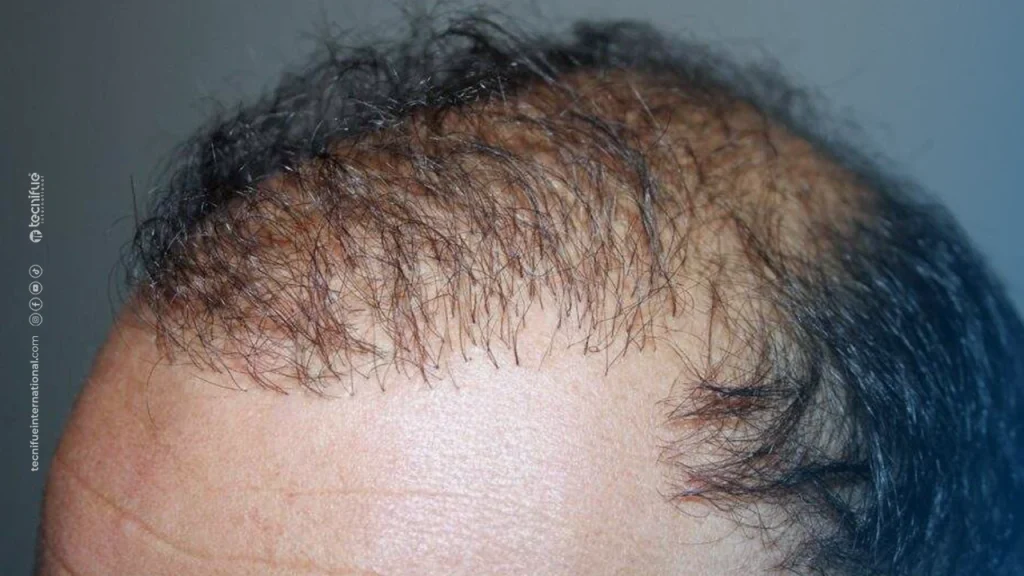 Bad Hair Transplant Result