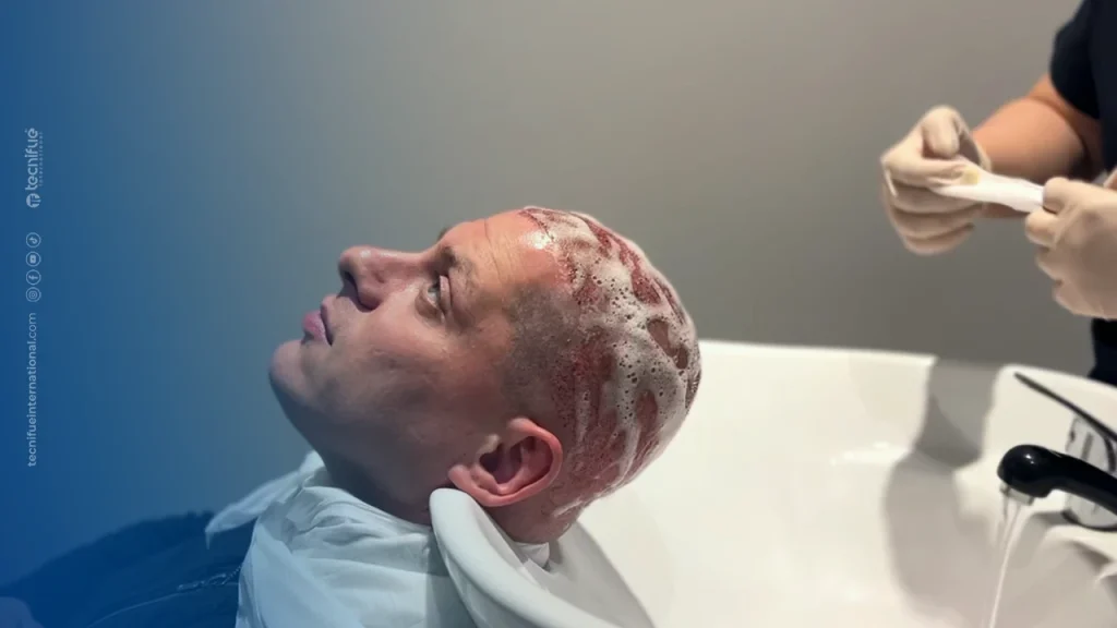 Washing after Hair Transplant