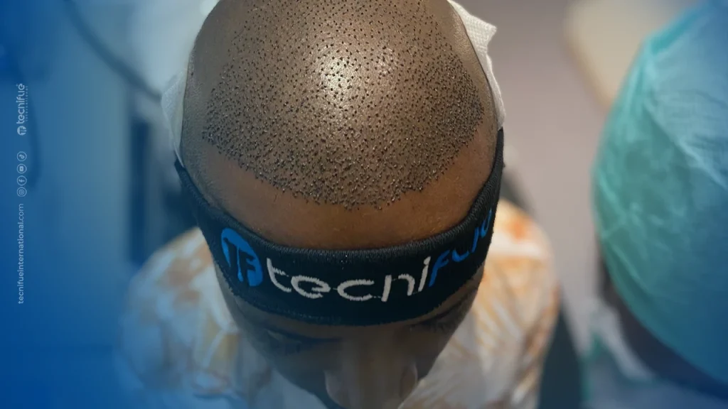 Band to Prevent Swelling in the Face