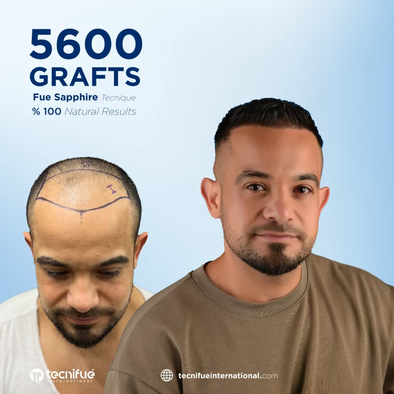 hair transplant before and after