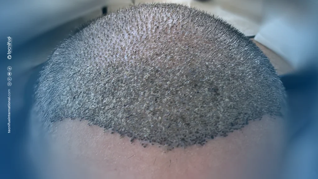 6th Day Post Op Scab Formation
