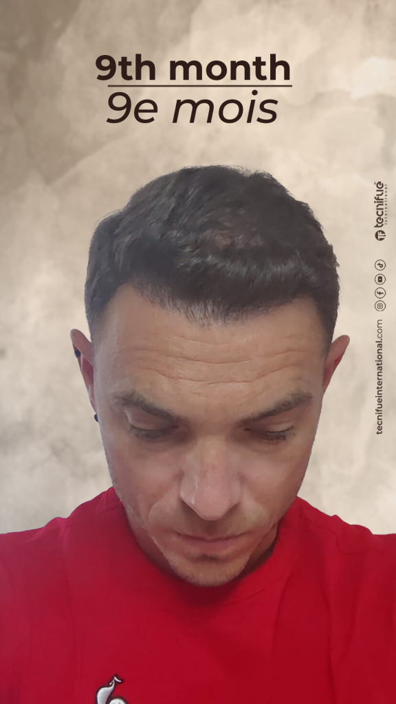Évolution de la greffe capillaire FUE : 9ème mois