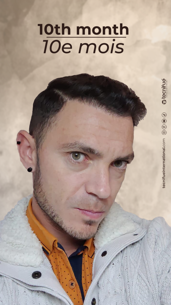 Évolution de la greffe capillaire FUE : 10ème mois