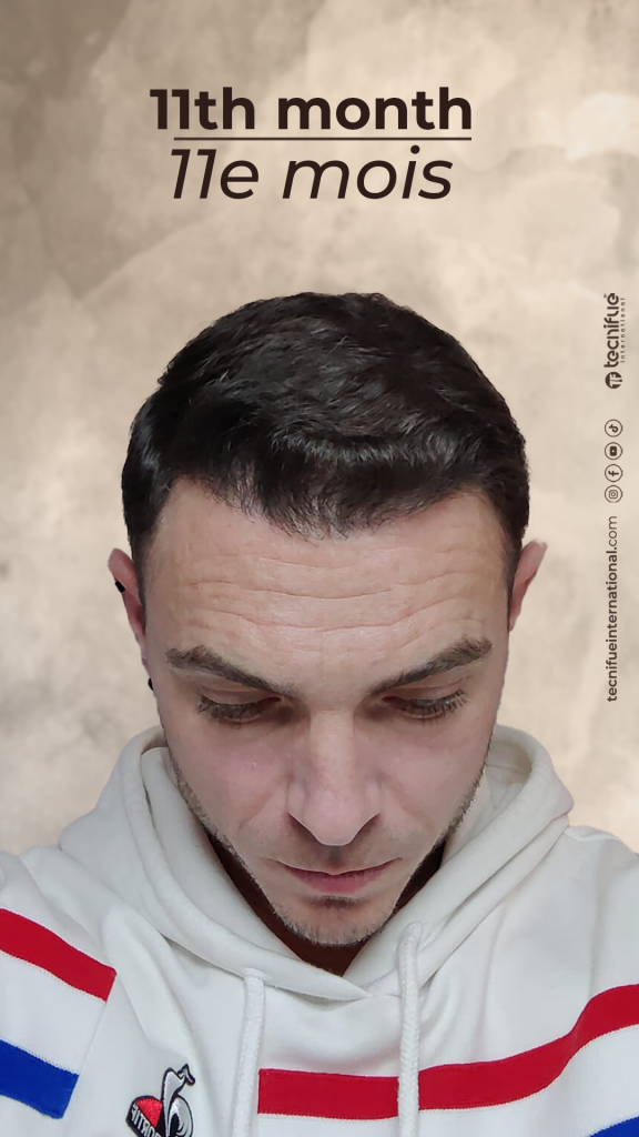 Évolution de la greffe capillaire FUE : 11ème mois